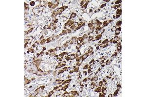 Immunohistochemistry of paraffin-embedded human liver cancer using Monoamine Oxidase B (MAOB) Rabbit pAb (ABIN3022151, ABIN3022152, ABIN3022153, ABIN1513172 and ABIN6218632) at dilution of 1:150 (40x lens).
