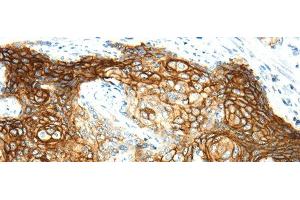 Immunohistochemistry of paraffin-embedded Human cervical cancer using AQP3 Polyclonal Antibody at dilution of 1/30 (AQP3 anticorps)