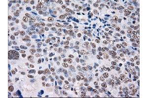 Immunohistochemical staining of paraffin-embedded Adenocarcinoma of colon tissue using anti-PSMD10mouse monoclonal antibody. (PSMD10 anticorps)