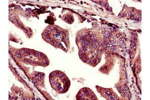 Immunohistochemistry of paraffin-embedded human prostate tissue using ABIN7169055 at dilution of 1:100 (UHMK1 anticorps  (AA 183-385))