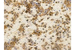 ABIN6265801 and ABIN6266839 at 1/100 staining human melanoma by IHC-P. (alpha Tubulin anticorps  (C-Term))