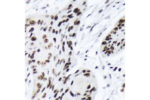 Immunohistochemistry of paraffin-embedded human esophageal cancer using A Rabbit mAb (ABIN7265699) at dilution of 1:100 (40x lens). (ARID1A anticorps)