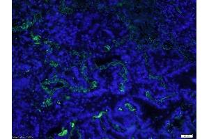 Formalin-fixed and paraffin-embedded human lung cancer labeled with Rabbit Anti-CD16 Polyclonal Antibody, Unconjugatedused at 1:200 dilution for 40 minutes at 37°C.