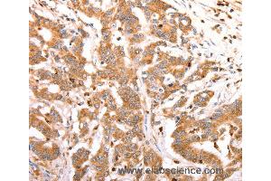 Immunohistochemistry of Human lung cancer using CELSR2 Polyclonal Antibody at dilution of 1:50 (CELSR2 anticorps)