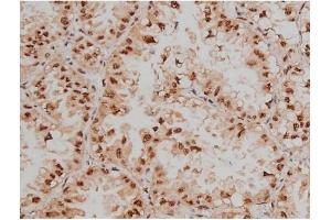 ABIN6267333 at 1/200 staining Human lung cancer tissue sections by IHC-P.