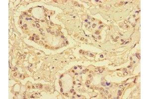 Immunohistochemistry of paraffin-embedded human pancreatic cancer using ABIN7166091 at dilution of 1:100 (MBTPS1 anticorps  (AA 17-70))