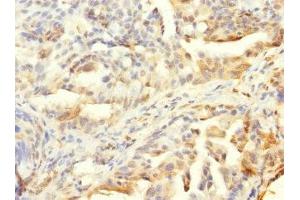 Immunohistochemistry of paraffin-embedded human lung cancer using ABIN7155913 at dilution of 1:100 (HCFC1R1 anticorps  (AA 1-119))