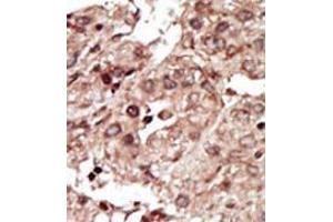 Formalin-fixed and paraffin-embedded human cancer tissue (hepatocarcinoma) reacted with the primary antibody, which was peroxidase-conjugated to the secondary antibody, followed by AEC staining. (PHKG1 anticorps  (Middle Region))