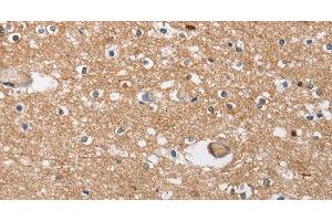 Immunohistochemistry of paraffin-embedded Human brain tissue using SOCS2 Polyclonal Antibody at dilution 1:40 (SOCS2 anticorps)