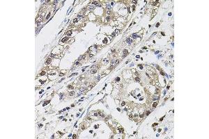 Immunohistochemistry of paraffin-embedded human gastric cancer using Carbonic Anhydrase 9 (C/G250) antibody (ABIN6131266, ABIN6137798, ABIN6137800 and ABIN6217767) at dilution of 1:100 (40x lens). (CA9 anticorps  (AA 52-151))