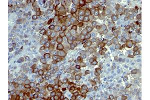 Formalin-fixed, paraffin-embedded human Melanoma stained with NGFR Monoclonal Antibody (NTR/912). (NGFR anticorps)