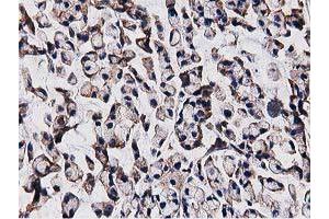 Immunohistochemical staining of paraffin-embedded Adenocarcinoma of Human colon tissue using anti-OGFOD1 mouse monoclonal antibody. (OGFOD1 anticorps)