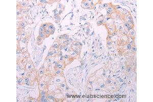 Immunohistochemistry of Human breast cancer using ADAMTS14 Polyclonal Antibody at dilution of 1:50 (ADAMTS14 anticorps)