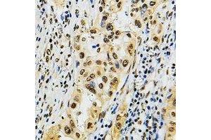 Immunohistochemical analysis of POLR3B staining in human lung cancer formalin fixed paraffin embedded tissue section. (POLR3B anticorps)