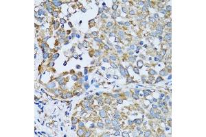 Immunohistochemistry of paraffin-embedded human lung cancer using RARS antibody (ABIN6127449, ABIN6146708, ABIN6146709 and ABIN6221913) at dilution of 1:100 (40x lens).