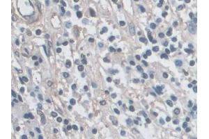 Detection of ERK1 in Human Prostate cancer Tissue using Polyclonal Antibody to Extracellular Signal Regulated Kinase 1 (ERK1)