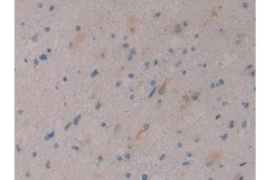 Detection of DKK3 in Human Glioma Tissue using Polyclonal Antibody to Dickkopf Related Protein 3 (DKK3) (DKK3 anticorps  (AA 22-350))