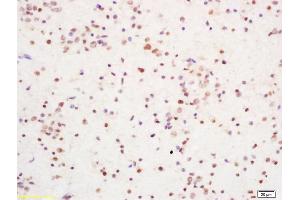 Formalin-fixed and paraffin embedded human brain glioblastoma labeled with Rabbit Anti YBX-1/YB1 Polyclonal Antibody, Unconjugated (ABIN759851) at 1:200 followed by conjugation to the secondary antibody and DAB staining (YBX1 anticorps)