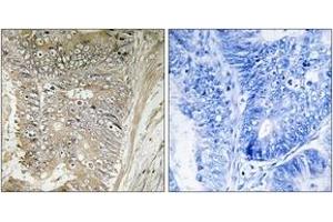 Immunohistochemistry analysis of paraffin-embedded human colon carcinoma tissue, using RPL37A Antibody. (RPL37A anticorps  (AA 21-70))
