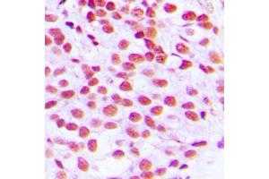 Immunohistochemical analysis of ELK1 staining in human breast cancer formalin fixed paraffin embedded tissue section. (ELK1 anticorps  (N-Term))