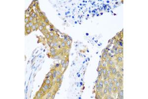 Immunohistochemistry of paraffin-embedded human lung cancer using YBX1 antibody. (YBX1 anticorps)