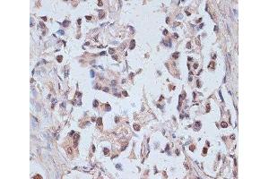 Immunohistochemistry of paraffin-embedded Human lung cancer using TAX1BP1 Polyclonal Antibody at dilution of 1:100 (40x lens). (TAX1BP1 anticorps)