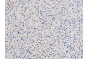ABIN6267525 at 1/200 staining Human ganstric cancer tissue sections by IHC-P.