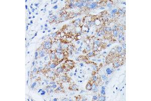 Immunohistochemistry of paraffin-embedded human liver cancer using MANBA antibody (ABIN7268392) at dilution of 1:100 (40x lens).
