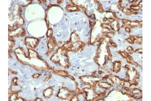 Formalin-fixed, paraffin-embedded human Angiosarcoma stained with CD31 Mouse Monoclonal Antibody (C31.