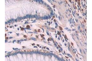 IHC-P analysis of Human Colorectal cancer Tissue, with DAB staining. (OAS1 anticorps  (AA 74-165))