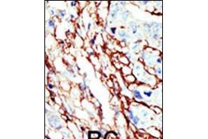 Formalin-fixed and paraffin-embedded human cancer tissue reacted with the primary antibody, which was peroxidase-conjugated to the secondary antibody, followed by AEC staining. (EPH Receptor A7 anticorps  (C-Term))
