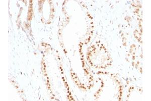 Formalin-fixed, paraffin-embedded human Prostate Carcinoma stained with p27 Mouse Monoclonal Antibody (SX53G8). (CDKN1B anticorps)