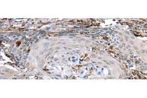 Immunohistochemistry of paraffin-embedded Human cervical cancer using TBXA2R Polyclonal Antibody at dilution of 1/40 (TBXA2R anticorps)