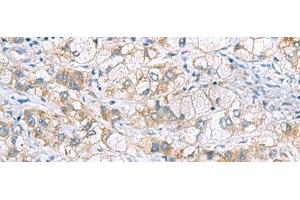Immunohistochemistry of paraffin-embedded Human liver cancer tissue using GCSH Polyclonal Antibody at dilution of 1:60(x200) (GCSH anticorps)