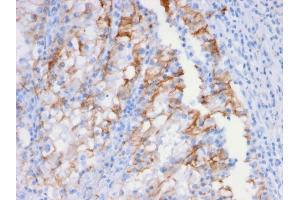 Formalin-fixed, paraffin-embedded human Renal Cell Carcinoma stained with Cadherin 16 Mouse Monoclonal Antibody (CDH16/2448).