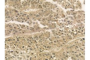 ABIN6265114 and ABIN6276812 at 1/100 staining human hepatocellular carcinoma by IHC-P.