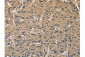 The image on the left is immunohistochemistry of paraffin-embedded Human liver cancer tissue using ABIN7129118(CYFIP2 Antibody) at dilution 1/25, on the right is treated with fusion protein. (CYFIP2 anticorps)