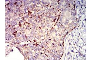 Immunohistochemical analysis of paraffin-embedded cervical cancer tissues using CD182 mouse mAb with DAB staining.