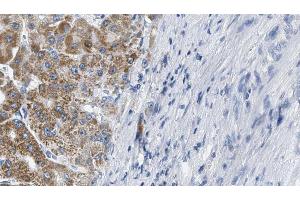 ABIN6274214 at 1/100 staining Human liver cancer tissue by IHC-P. (MARK3 anticorps  (N-Term))