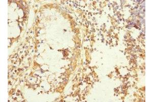 Immunohistochemistry of paraffin-embedded human colon cancer using ABIN7165806 at dilution of 1:100 (MEMO1 anticorps  (AA 1-297))