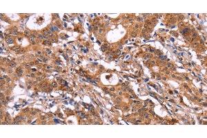 Immunohistochemistry of paraffin-embedded Human gastic cancer using SIGLEC5 Polyclonal Antibody at dilution of 1:30 (SIGLEC5 anticorps)