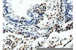 Immunohistochemical staining of paraffin-embedded Adenocarcinoma of Human breast tissue using anti-NT5DC1 mouse monoclonal antibody. (NT5DC1 anticorps)