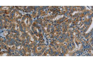 Immunohistochemistry of paraffin-embedded Human thyroid cancer tissue using PPARGC1B Polyclonal Antibody at dilution 1:30 (PPARGC1B anticorps)
