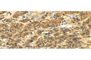 Immunohistochemistry of paraffin-embedded Human liver cancer tissue using SLC6A19 Polyclonal Antibody at dilution 1:35 (SLC6A19 anticorps)
