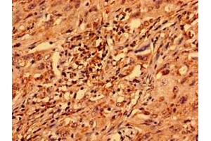 Immunohistochemistry analysis of human lung cancer using ABIN7176355 at dilution of 1:100 (ZNF529 anticorps  (AA 393-563))