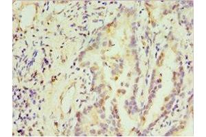 Immunohistochemistry of paraffin-embedded human lung cancer using ABIN7171237 at dilution of 1: 100 (STX3 anticorps  (AA 1-263))