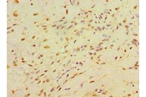 Immunohistochemistry of paraffin-embedded human breast cancer using ABIN7146714 at dilution of 1:100 (CA14 anticorps  (AA 16-290))