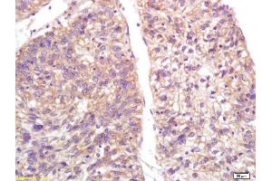 Formalin-fixed and paraffin embedded human lung carcinoma labeled with Anti-S100-A9/MRP14/CFAG/Calgranulin B Polyclonal Antibody, Unconjugated (ABIN749288) at 1:200, followed by conjugation to the secondary antibody and DAB staining
