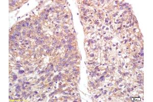 Formalin-fixed and paraffin embedded human lung carcinoma labeled with Anti-S100-A9/MRP14/CFAG/Calgranulin B Polyclonal Antibody, Unconjugated (ABIN749288) at 1:200, followed by conjugation to the secondary antibody and DAB staining (S100A9 anticorps  (AA 51-114))