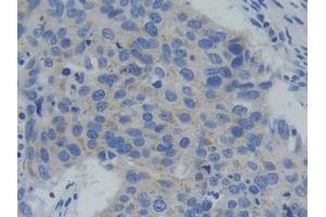 Detection of PFKP in Human Lung cancer Tissue using Polyclonal Antibody to Phosphofructokinase, Platelet (PFKP) (PFKP anticorps  (AA 553-753))